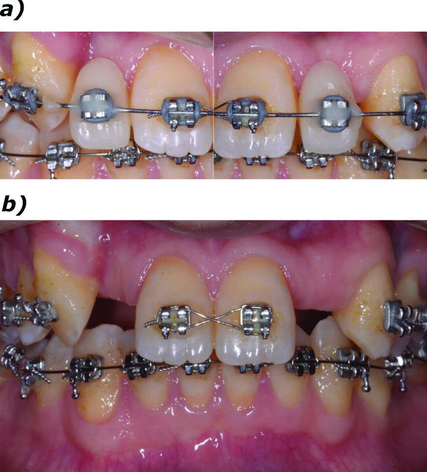 Fig. 1_Presentazione del caso. Il paziente presenta agenesia bilaterale degli incisivi secondari superiori; a) trattamento conservativo con provvisori in resina solidarizzati all’apparecchio ortodontico e a sola funzione estetica; b) trattamento ortodontico per l’ottimizzazione del piano occlusale e dello spazio mesio-distale.