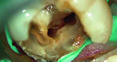 The role of the operating microscope - in conjunction with ultrasonic in preparation of root canal systems