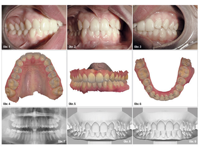 F22 Aligners