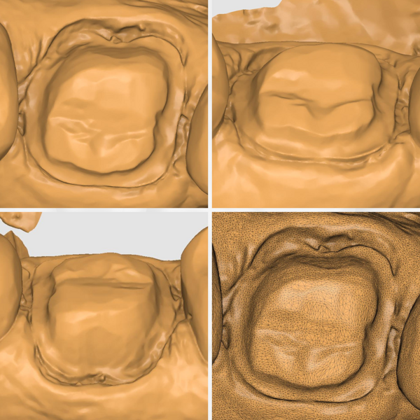 Fig. 10: Preparation margins on the CEREC Primescan scan.