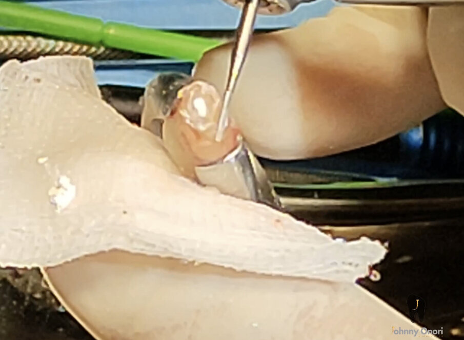  Figg. 5a-5d - Chirurgia apicale. Retro-preparazione con punte ad ultrasuoni (a & b) e retro-otturazione con CeraPutty (Meta Biomed) (c & d).