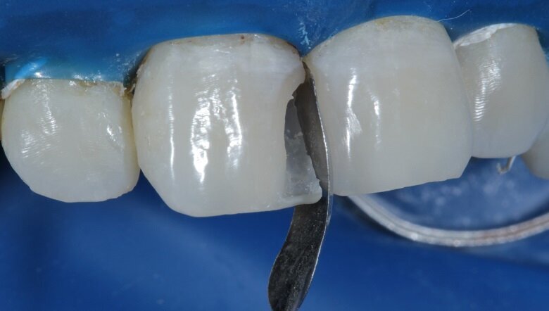 Fig 14: Proximal View of band placed