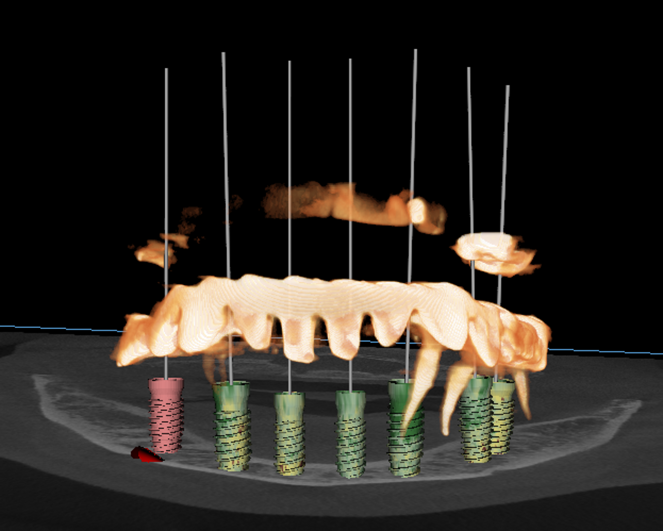 Fig. 4: Implant planning and parallelisation with YomiPlan.