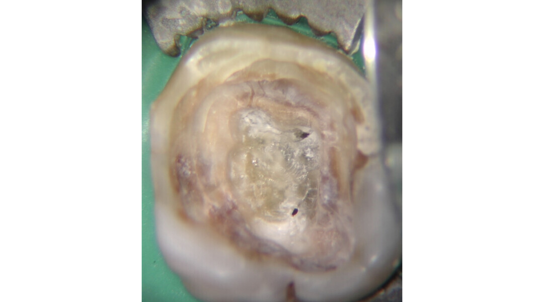 Fig. 23: Identification of two canal orifices inside the calcified tissue that must be removed before proceeding to the probing and shaping step.