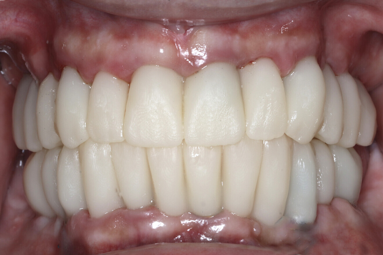 Fig. 16b: Retracted intra-oral view.