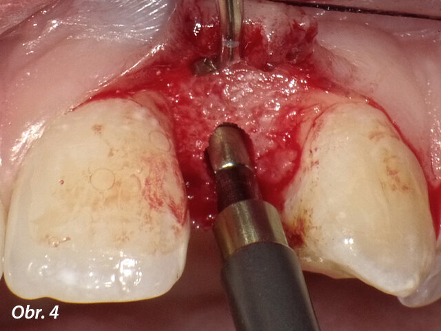 Poslední ruční rozšiřovač o průměru 3 mm se rukou opatrně vtlačí mezi dva kořeny. Řezná hrana směřuje k patrové kosti a rotace je vedena maximálně v úhlu 45 °.