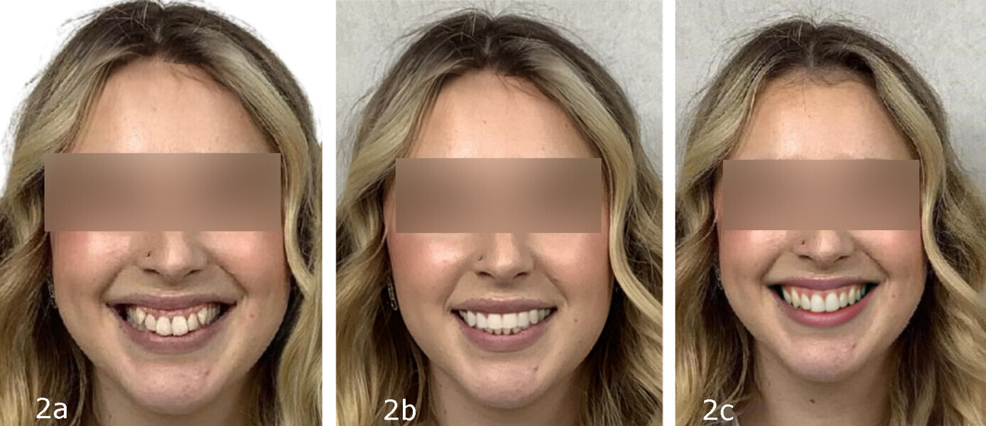 Figs. 2a–c: Aligner simulation software from Invisalign: before (a) and after simulation (b) compared with Smile Geni after treatment simulation (c).