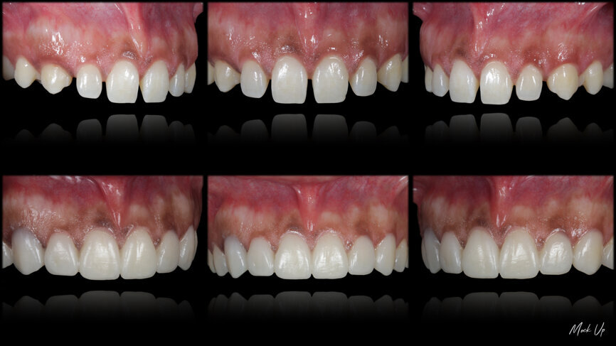 Fig. 48: Mock-up procedures and result in the mouth in order to evaluate the aesthetic relation between the face and the smile.
