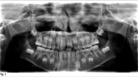 Le futur de l'endodontie : la revascularisation pulpaire