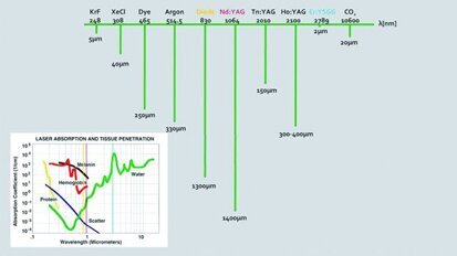 Utilisation clinique du laser Er,Cr:YSGG dans le traitement endodontique