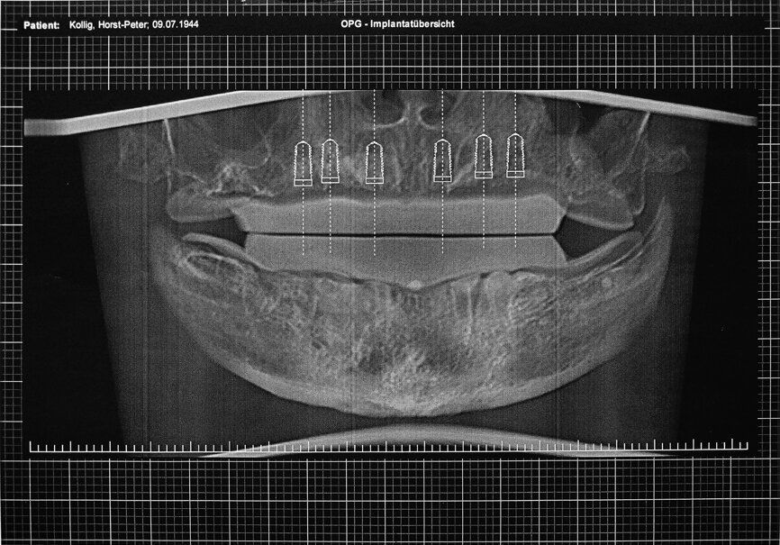 Figs. 12a et b : Tomographie panoramique dentaire virtuelle montrant les positions des implants numériquement définies en 3D dans le maxillaire (a) et la mandibule (b). 