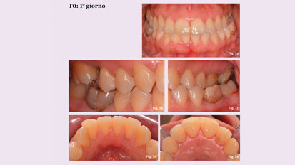 Trattamento di una Parodontite Stadio III Grado C con CHX 0,12%+CPC 0,05% e dentifricio Vitis  antistain
