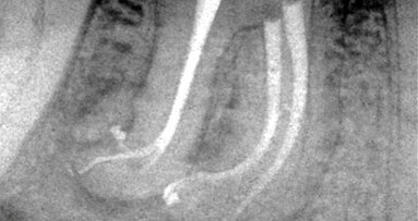 Negotiating around anatomic impediments: Tactile clues, bypass techniques, procedural flow