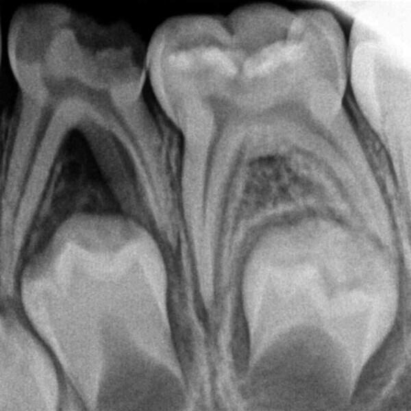 Fig. 6 : Quatre longs canaux radiculaires ont été détectés.