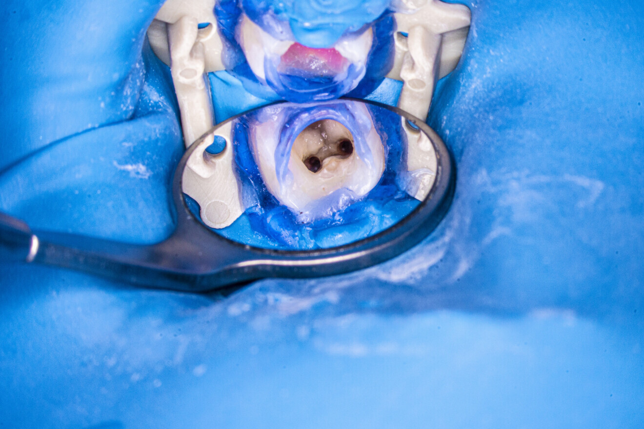 Fig. 8: Pulp chamber after the irrigation protocol.