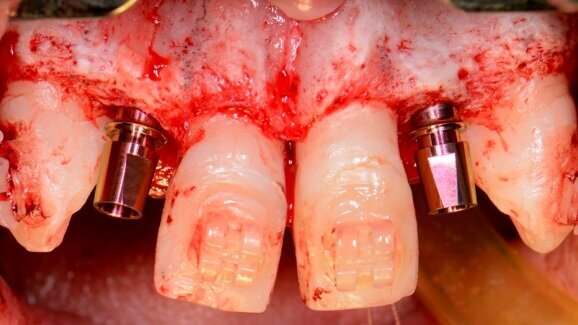 Zespołowe postępowanie terapeutyczne w przypadku wrodzonej hipodoncji siekaczy bocznych w szczęce