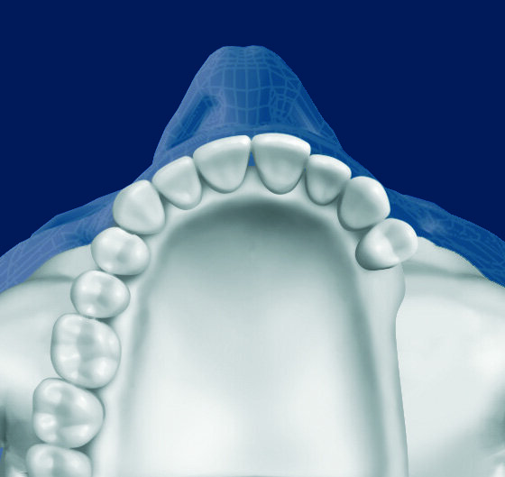 Figg. 1, 2_Schema di atrofia ossea verticale e trasversale posteriore del mascellare superiore.