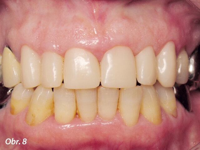 Zkouška provizorních korunek