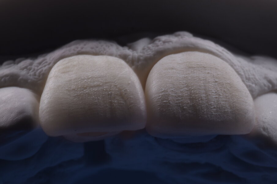 Figg. 3-5 - Stessa tecnica di tessitura eseguita su materiali diversi: denti in ceramica e in resina.