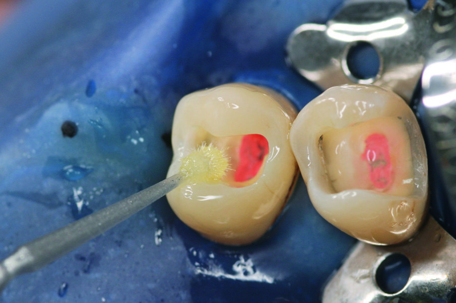 Fig: 4. After rinsing and drying of the cavity the universal adhesive Prime&Bond universal™ was applied. The adhesive was gently air-blowed and light-cured.