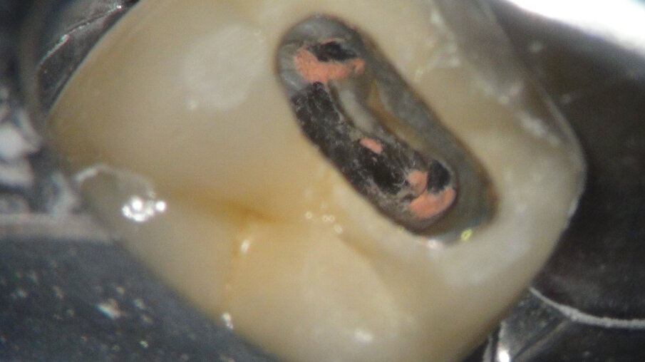 Afbeelding 10. Het is mogelijk dat we 4 jaar geleden een MidMesial gemist hebben.