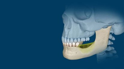 Orthognatic Surgery: Understanding the basics