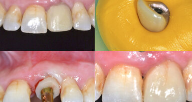 Técnica alternativa de impresión para la reproducción del perfil de emergencia