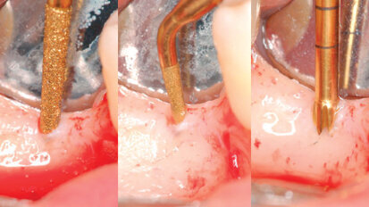 Una nuova tecnica per la preparazione del sito implantare con l’impiego della chirurgia piezoelettrica (PES)