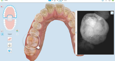 מחקר קליני מאמת כלי עזר חדש לאיתור וניטור נגעי עששת אינטרה -פרוקסימליים