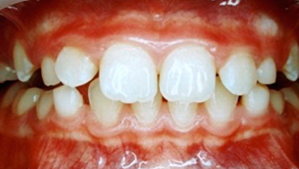 Evolución del tratamiento miofuncional postural con los sistemas de MRC (3)