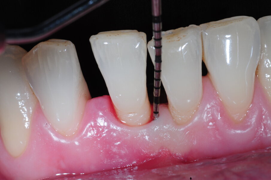 Figg. 6a, 6b - Sondaggio iniziale del difetto.