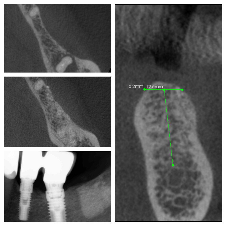 Fig. 7_Primo caso eseguito nel 2011, rx di controllo a 3 anni dal posizionamento implantare.