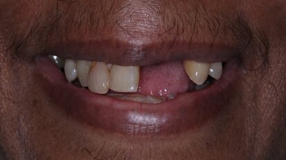 Tooth loss in Middle-aged is linked to increased coronary heart disease risk