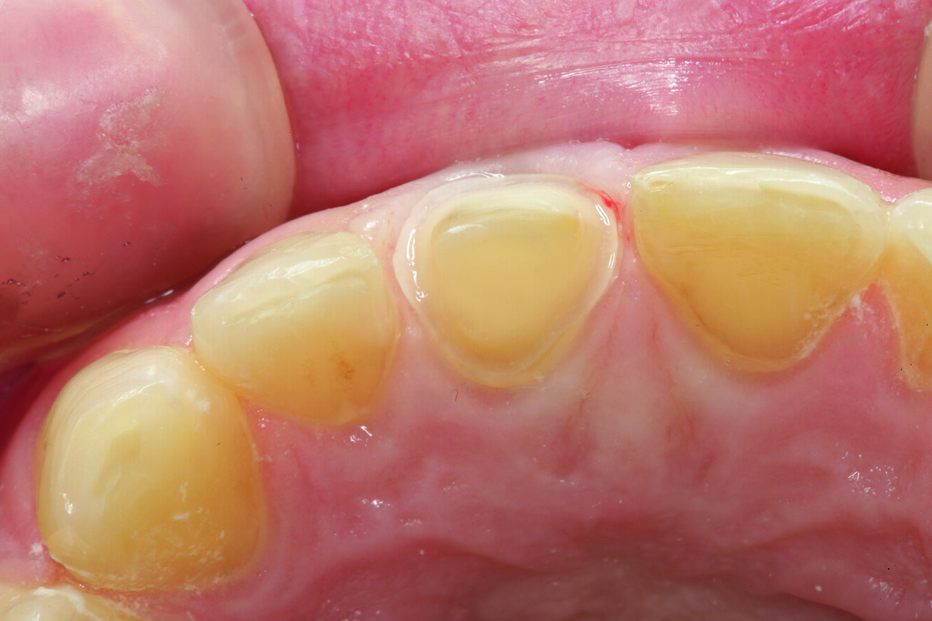 Fig. 11a: Incisal view .