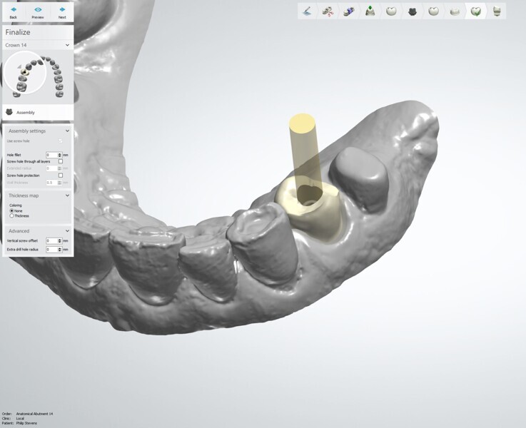 Fig. 6: Provisional restoration design on 3Shape Implant Studio.