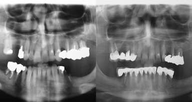 Dall’errata progettazione al fallimento del piano terapeutico ripercorrendo le criticità di un caso con l’odontologo forense