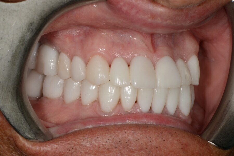Fig. 32f: Right view of the teeth in intercuspal position. 