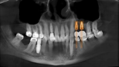 Digital Sinus Planning (DSP) Protocol: Protocollo digitale per programmare una rigenerazione ossea verticale/orizzontale