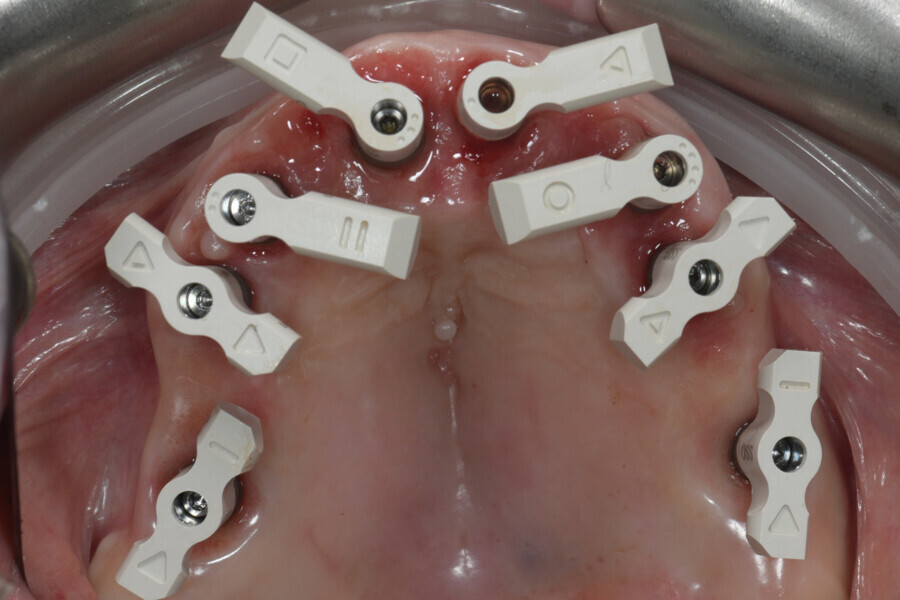 Fig. 13: SmartFlag scan bodies in place for an intra-oral impression.