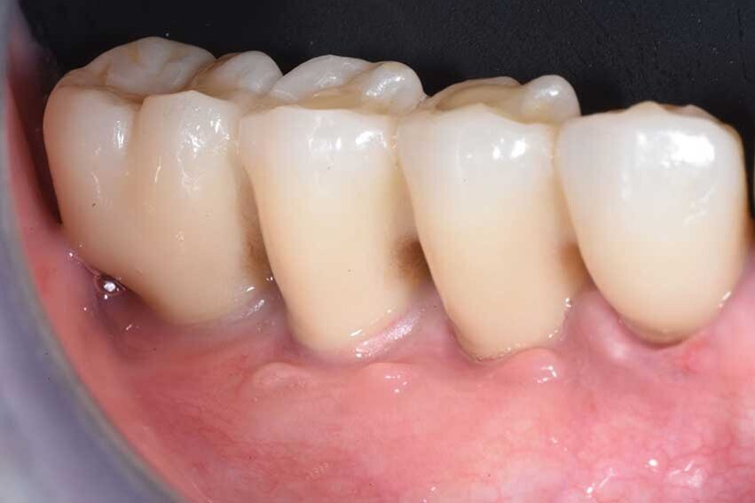 Fig. 14 - Le corone definitive in posizione.
