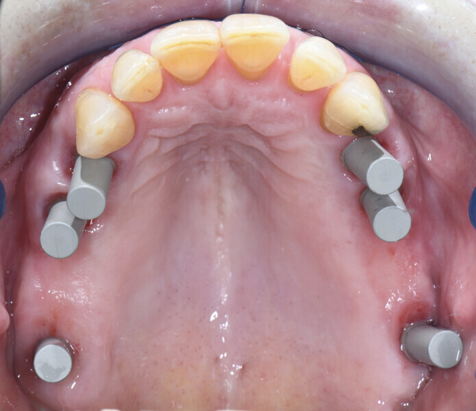 Fig. 8: Atlantis IO FLO-S scan bodies seated on MultiBase Abutments EV.