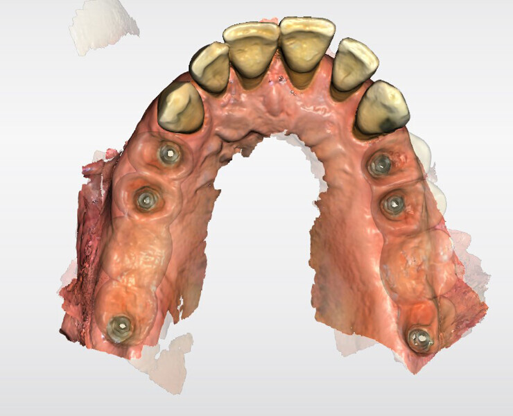 Fig. 7: Soft-tissue scan, allowing design of the Atlantis BridgeBase for proper cleaning.