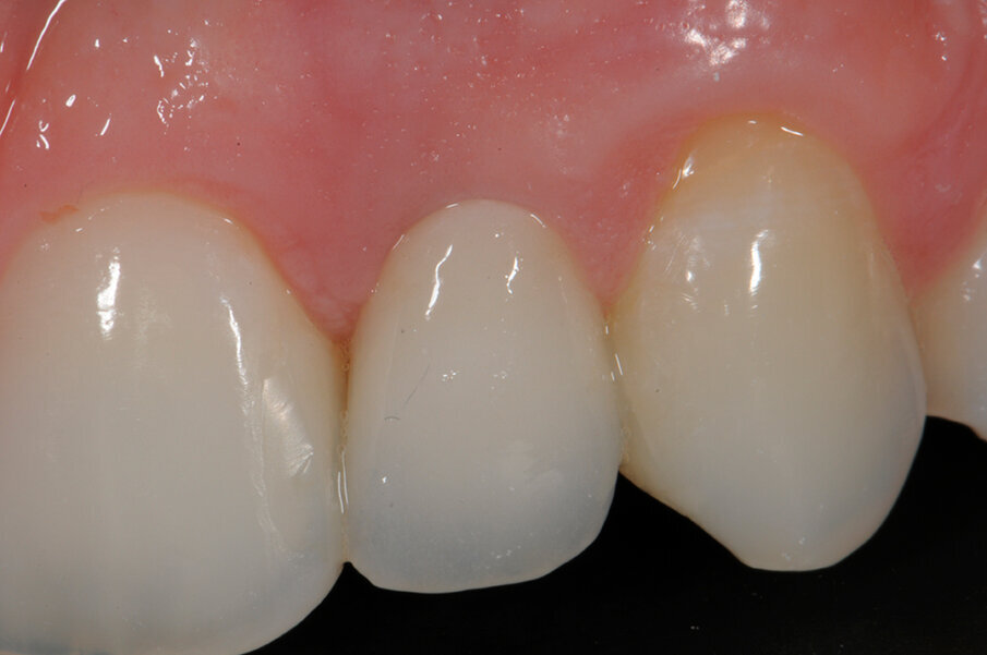 Fig. 6c - Controllo dei tessuti molli a un mese.