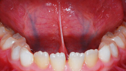 Analisi della variazione posturale cervicale prima e dopo la frenulotomia linguale laser