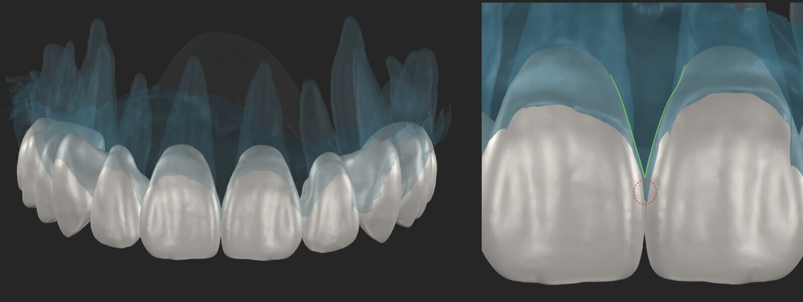 Fig. 9: Design with custom support to the papillae.