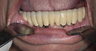 Periimplantitis – przegląd piśmiennictwa w oparciu o wybrane przypadki własne