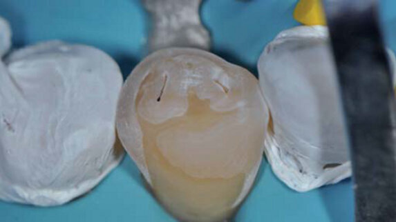 ADF 2015 : L’érosion, le nouvel ennemi ?