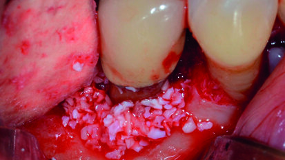 Rigenerazione Tissutale Guidata (G.T.R.) di un difetto intraosseo circonferenziale: caso clinico