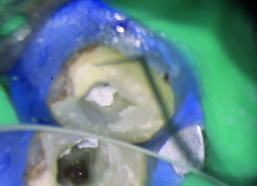 Fig. 9 : Fragment retiré encore attaché à la boucle du fil métallique