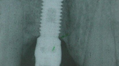 La Distrazione Alveolare. Interesse nel ripristino o la preservazione dell'estetica dei settori anteriori